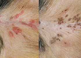 Photo of hyperpigmentation