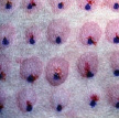 Photo of intradermal testing